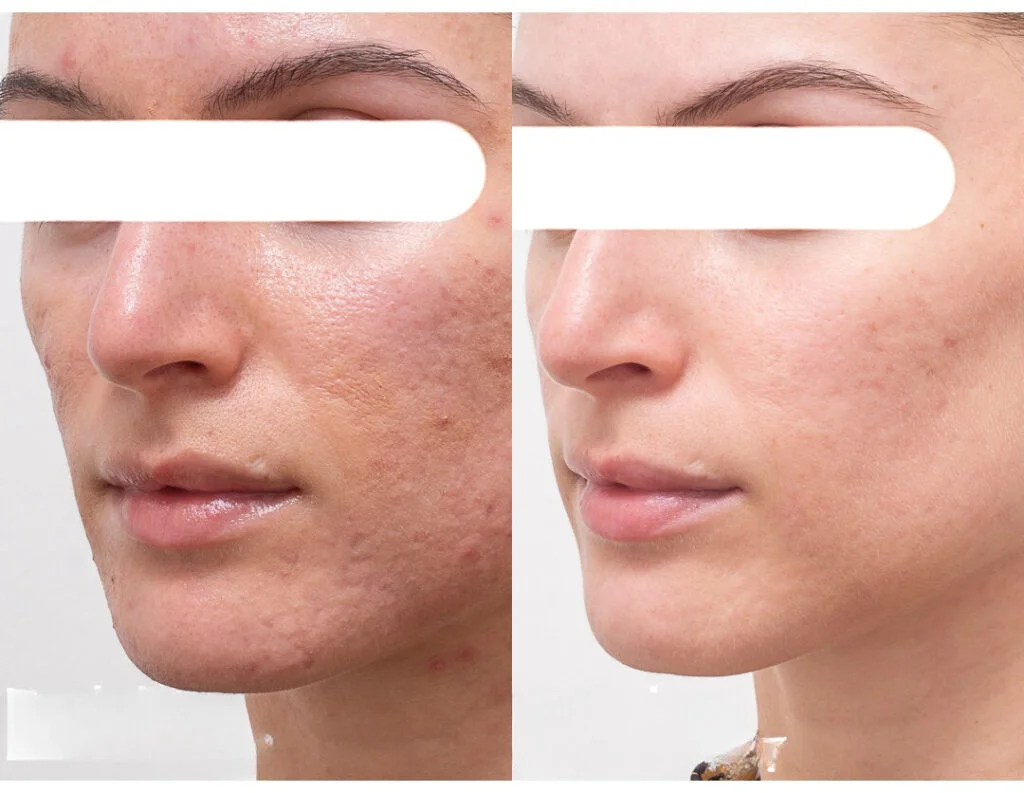 آر‌اف فرکشنال (RF Fractional) چیست