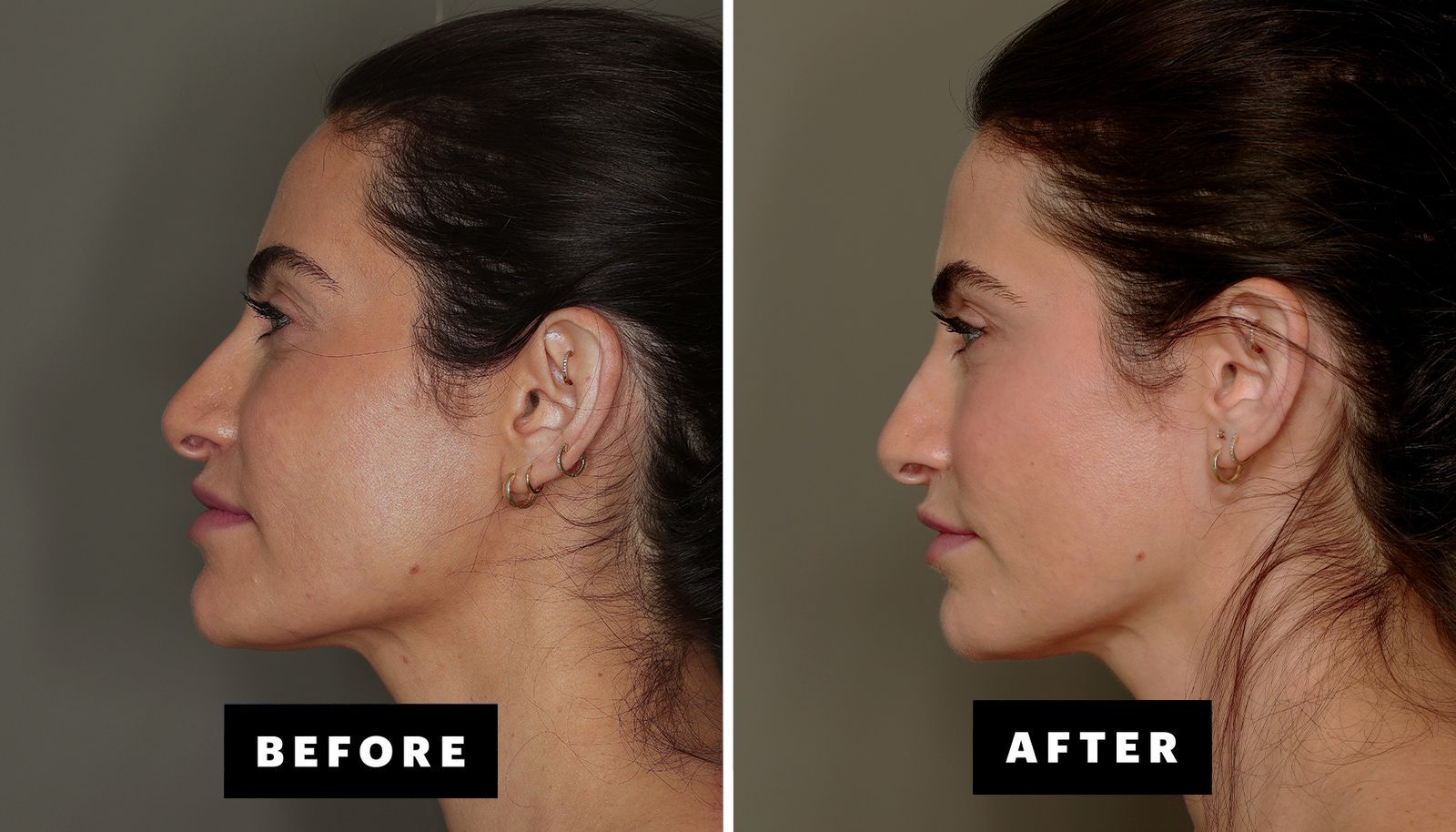 تزریق چربی پوست (Fat Grafting)؛ جوانسازی طبیعی و ماندگار صورت و بدن