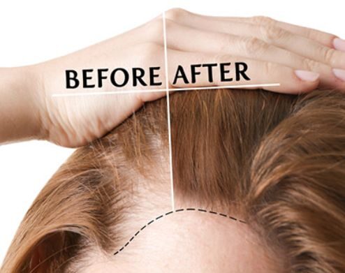 مزوتراپی مو (Mesotherapy Hair)؛ درمان نوین ریزش مو و تقویت رشد طبیعی